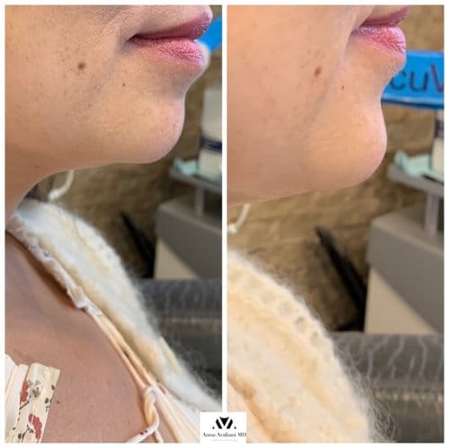 Non Surgical Chin Augmentation before and after, result 8