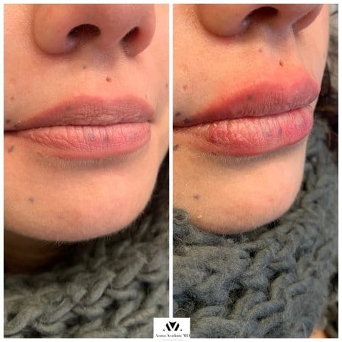 Lip Augmentation before and after, result 8