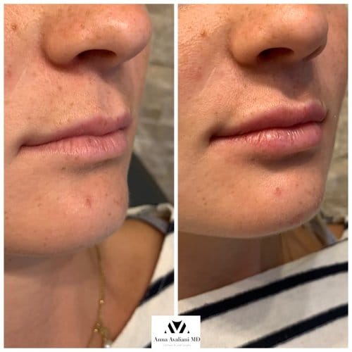 Lip Augmentation before and after, result 9