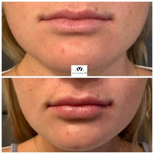 Lip Augmentation before and after, result 10