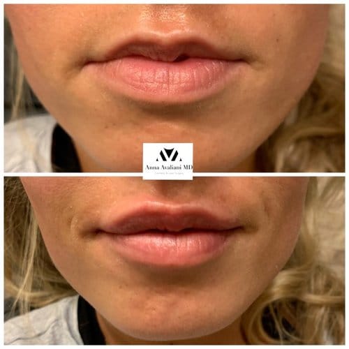 Lip Augmentation before and after, result 11