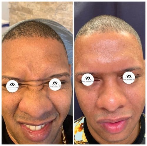 Botox before and after, result 9
