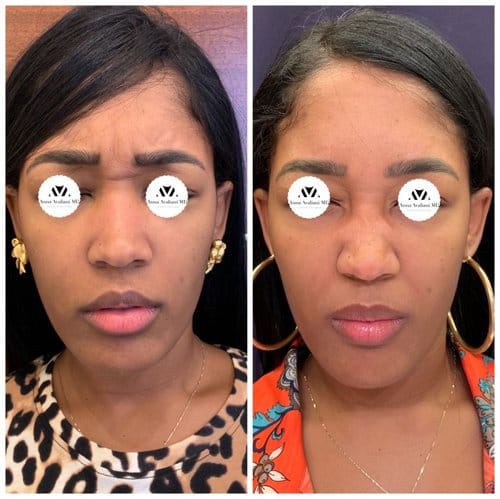 Botox before and after, result 10