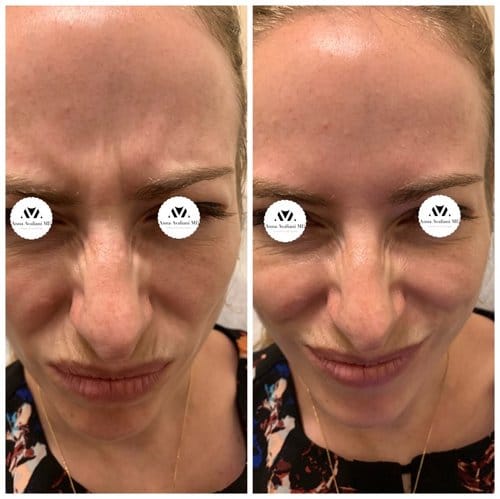 Botox before and after, result 11