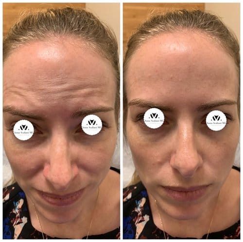 Botox before and after, result 12