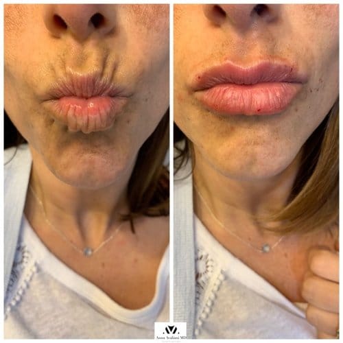 Lip Augmentation before and after, result 12