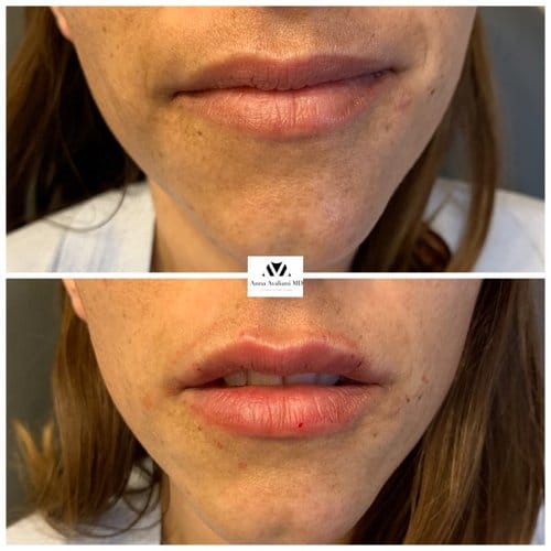 Lip Augmentation before and after, result 13