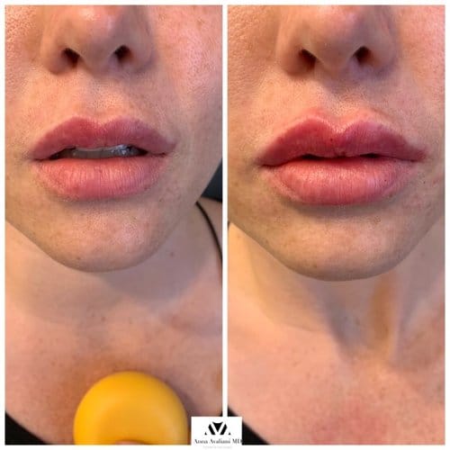 Lip Augmentation before and after, result 14