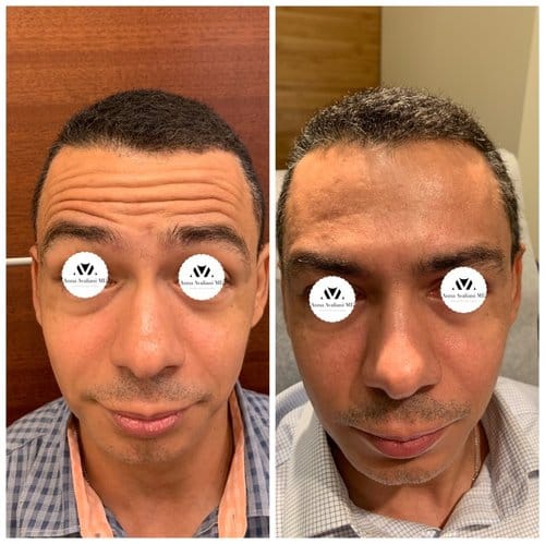Botox before and after, result 13