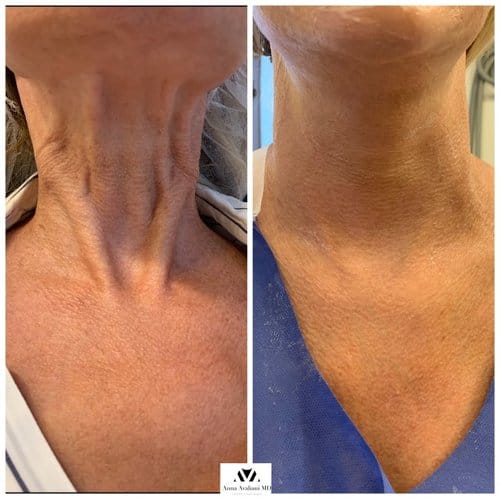Botox before and after, result 14