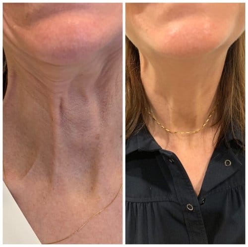 Botox before and after, result 15