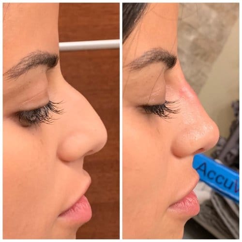 Non Surgical Nose Job before and after, result 10
