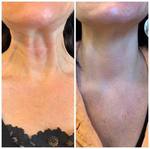 Botox before and after, result 16