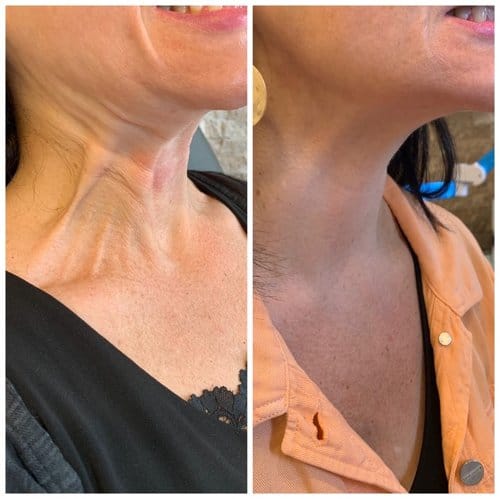 Botox before and after, result 17