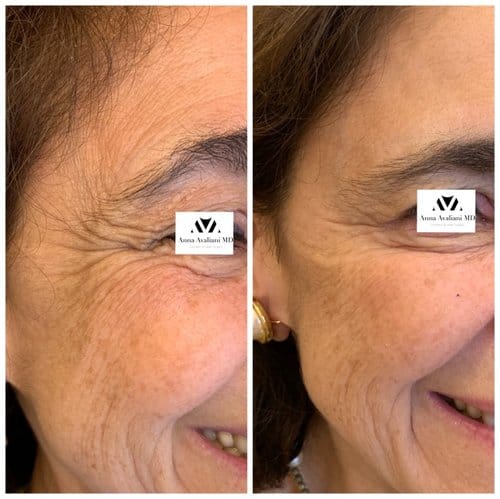 Botox before and after, result 18