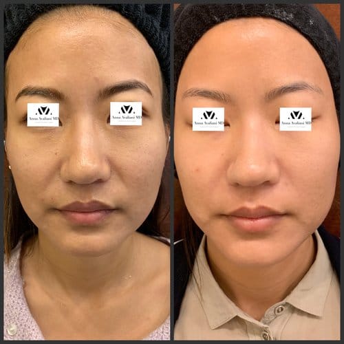 PicoSure / Laser Skin Rejuvenation before and after, result 8