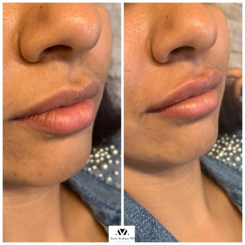 Lip Augmentation before and after, result 16