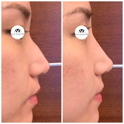 Non Surgical Nose Job before and after, result 11