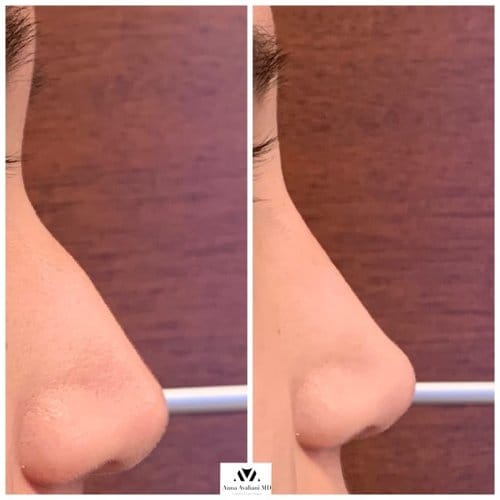 Non Surgical Nose Job before and after, result 12