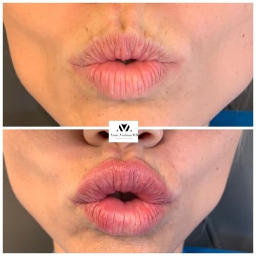 Lip Augmentation before and after, result 17
