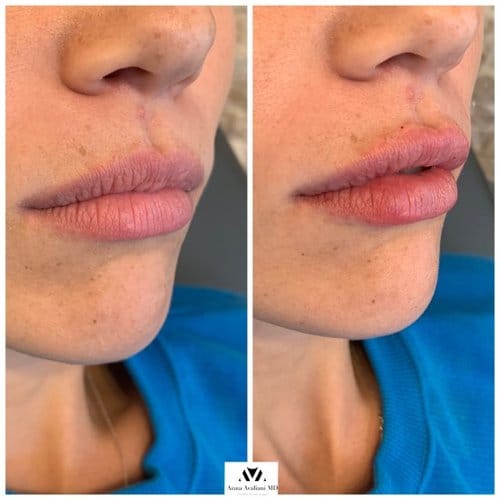 Lip Augmentation before and after, result 18