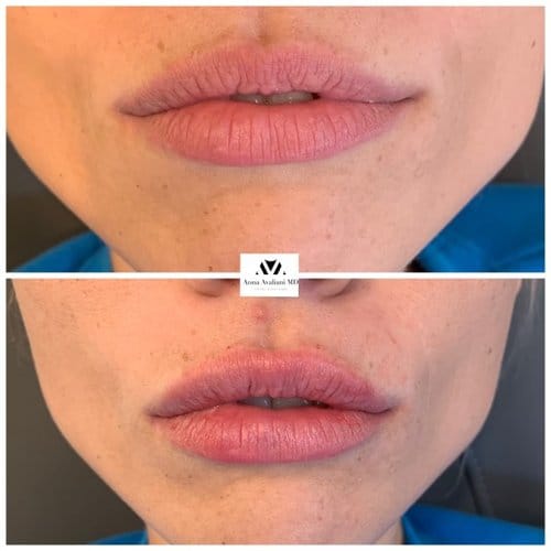 Lip Augmentation before and after, result 19