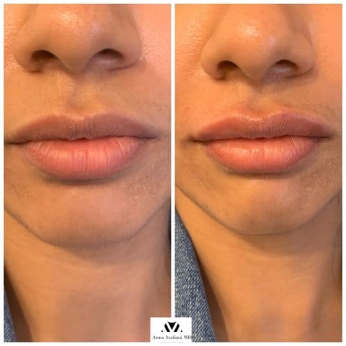 Lip Augmentation before and after, result 20