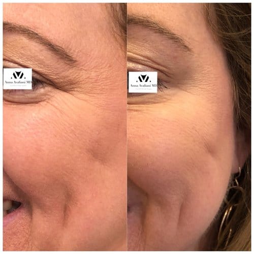 Botox before and after, result 19