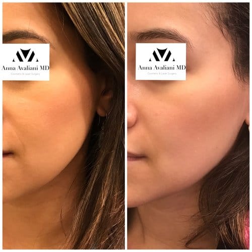 Fillers before and after, result 30