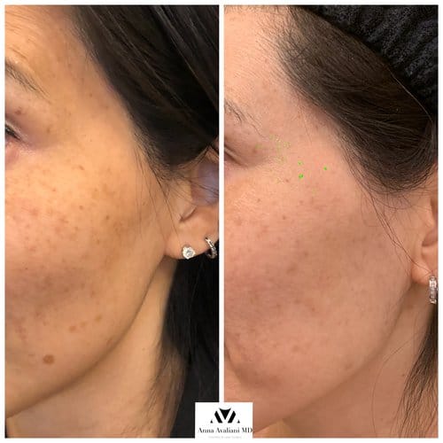 PicoSure / Laser Skin Rejuvenation before and after, result 9