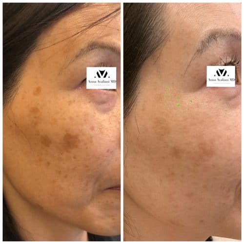 PicoSure / Laser Skin Rejuvenation before and after, result 10