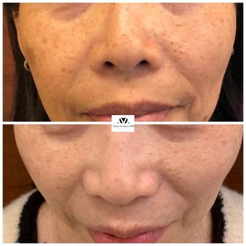 PicoSure / Laser Skin Rejuvenation before and after, result 11