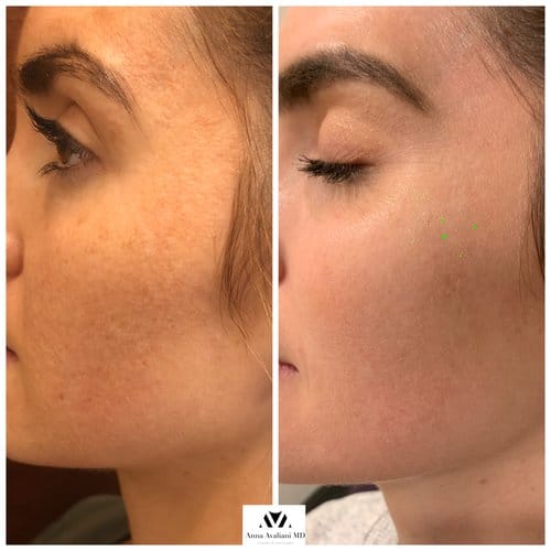 PicoSure / Laser Skin Rejuvenation before and after, result 12