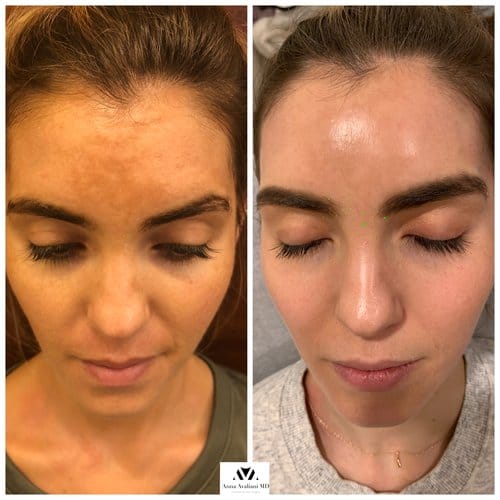 PicoSure / Laser Skin Rejuvenation before and after, result 13