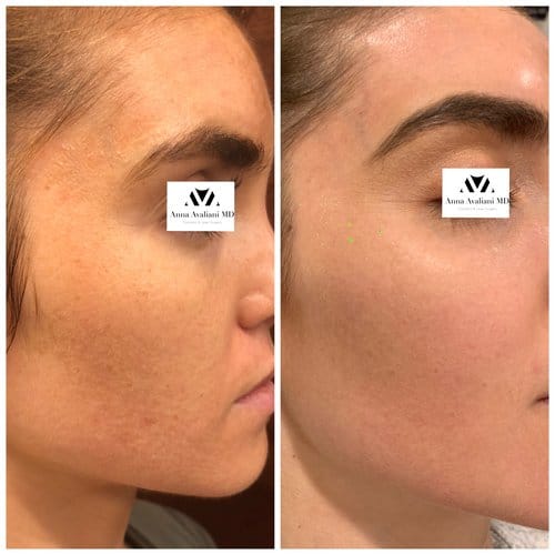 PicoSure / Laser Skin Rejuvenation before and after, result 14