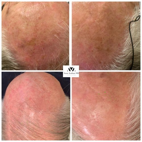 PicoSure / Laser Skin Rejuvenation before and after, result 15