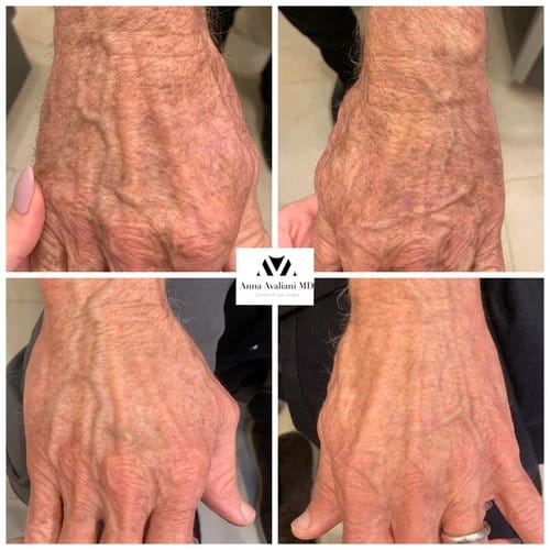PicoSure / Laser Skin Rejuvenation before and after, result 16