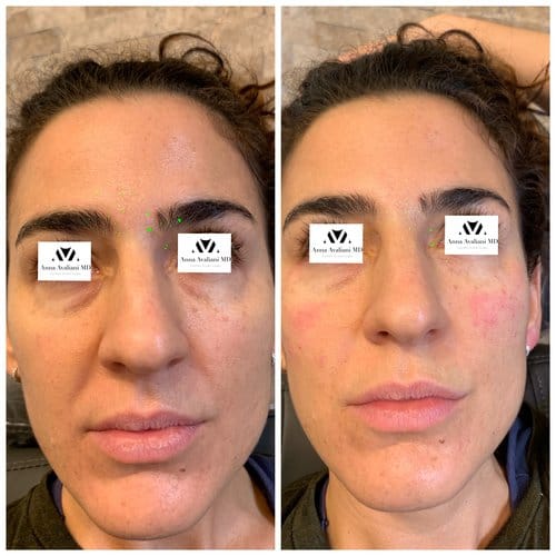 Fillers before and after, result 3