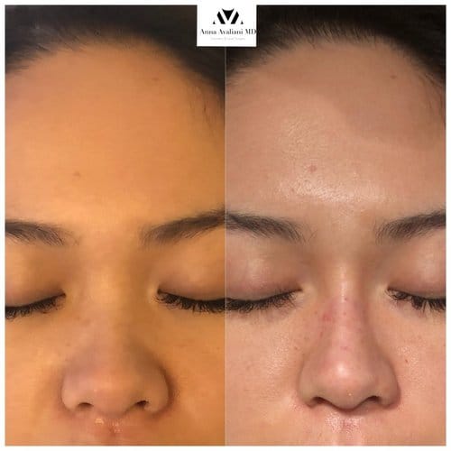 Non Surgical Nose Job before and after, result 13