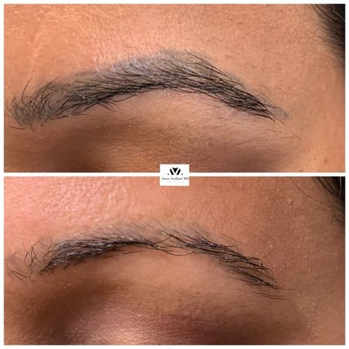 Tattoo Eyebrow Removal before and after, result 7