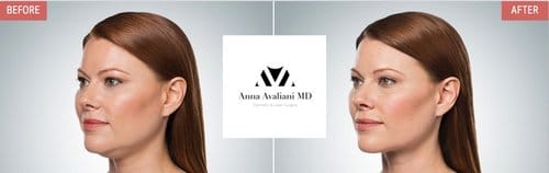 Kybella before and after, result 1