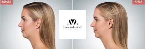 Kybella before and after, result 10