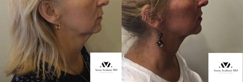 Kybella before and after, result 11