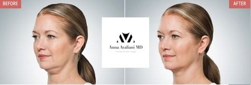 Kybella before and after, result 2
