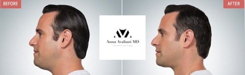 Kybella before and after, result 3