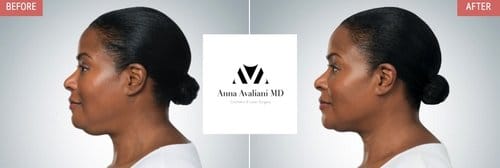 Kybella before and after, result 4