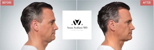 Kybella before and after, result 5