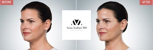 Kybella before and after, result 6