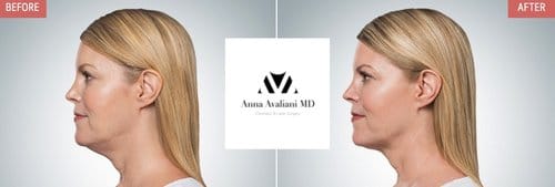 Kybella before and after, result 7