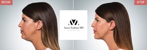 Kybella before and after, result 8